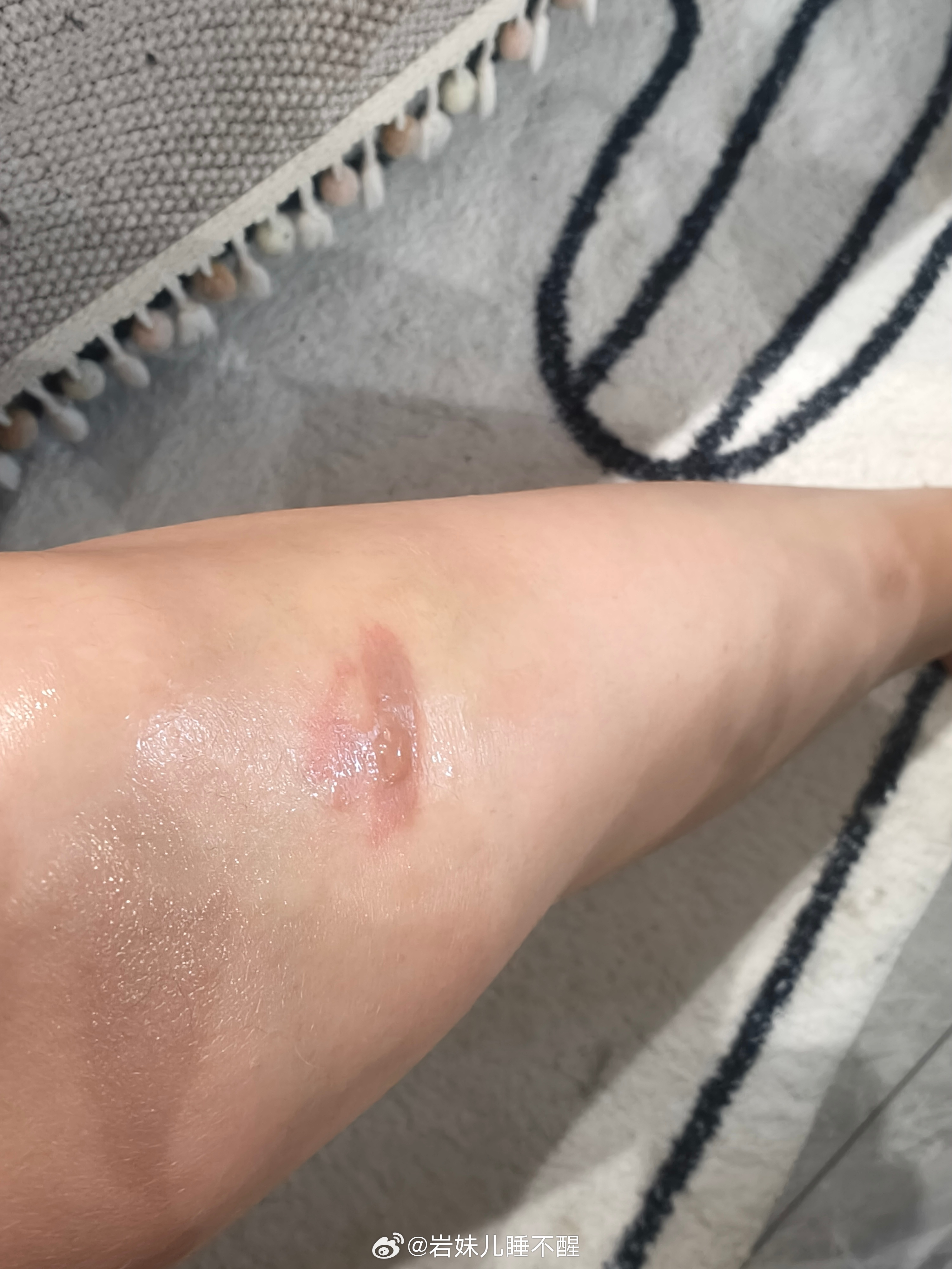 腿被烧烤签子扎伤应急处理指南