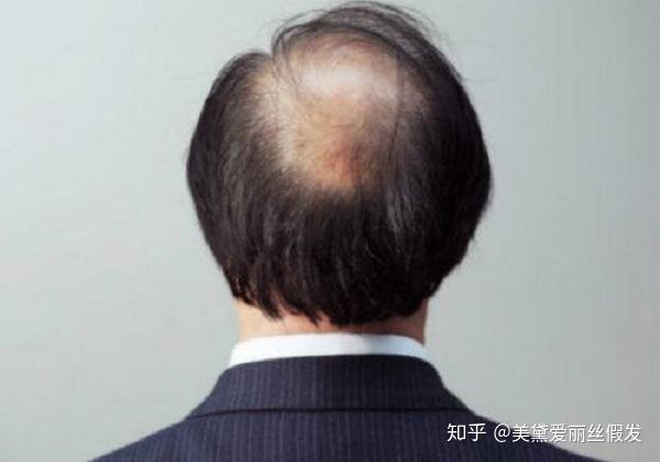 女子因脱发困扰，30岁竟被误认为奶奶？关于脱发的十大反思与行动指南