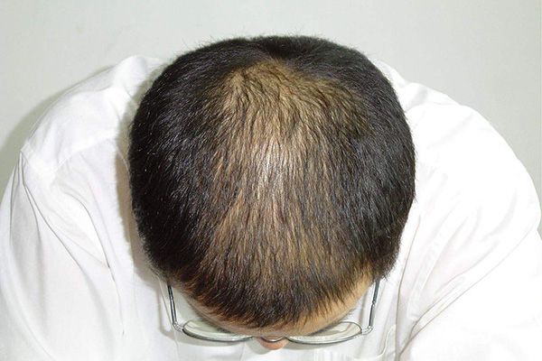 女子因脱发困扰，30岁竟被误认为奶奶？关于脱发的十大反思与行动指南