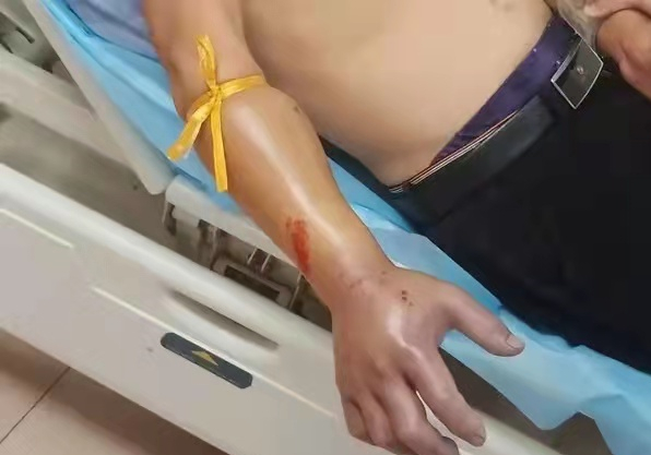 小伙被五步蛇咬伤，惊魂经历与应对之道