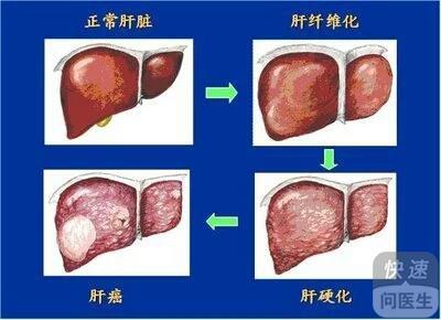 肝出现纤维化能治得好吗？全面解读与应对策略